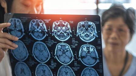 Genetic mutation could unlock new ways to treat dementia