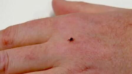 Revised Lyme Disease Statistics Raise New Questions