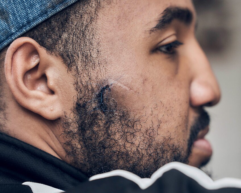 Detail of Deon Jones' fractures on his face after police violence during protests. | Shayan Asgharnia
