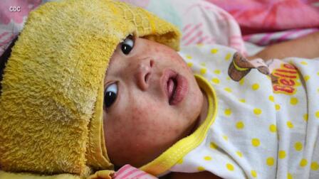 MEASLES: STATE OF EMERGENCY!