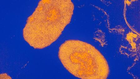 These non-Ebola diseases are the real health threat