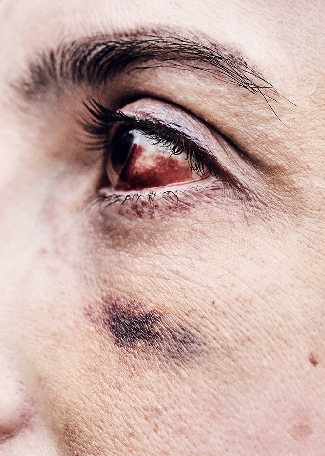 Rachel's bloody eye in shown in detail. She participated in a Black Lives Matter rally. | Shayan Asgharnia