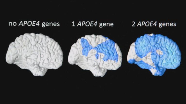 Predicting Alzheimer’s