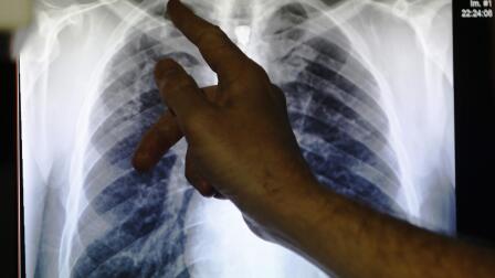 New drugs may stop TB, world's top infectious killer