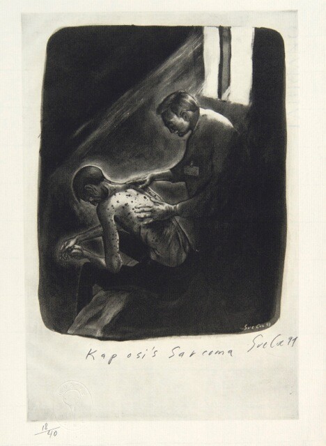 Sue Coe, "Kaposi's Sarcoma," 1994, 13 x 9 1â„2 in. Photo-etching on paper. Pomona College Collection. Museum purchase with funds provided by the Estate of Walter and Elise Mosher.
