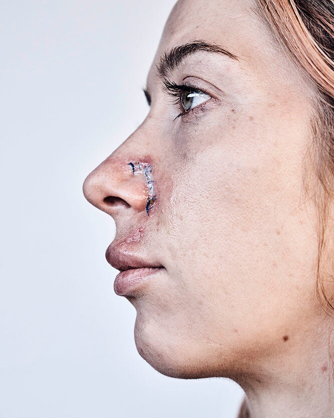 Trish Hill, who had her hands up in the air, had to get stitches on her nose after being shot in the face with a rubber bullet by police. | Shayan Asgharnia