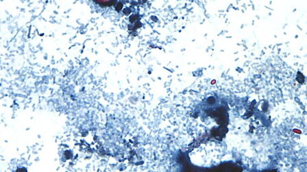What we know about cyclosporiasis outbreak's link to produce outbreak