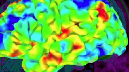 Alzheimer's May Be More Complicated