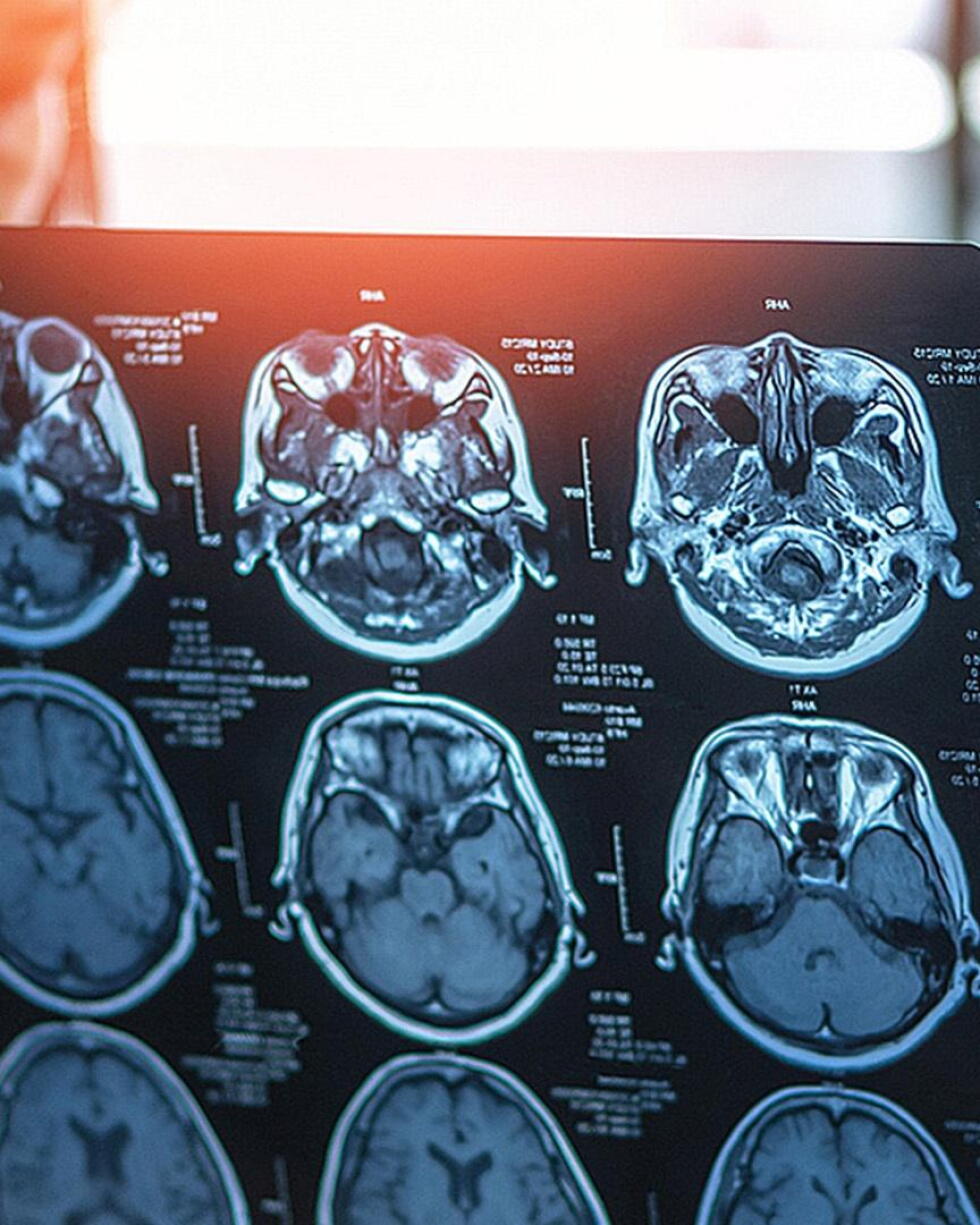 Genetic mutation could unlock new ways to treat dementia