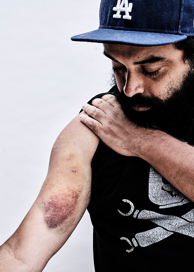 Daniel Chavez was shot in the arm and in the back of the head while filming LA County sheriffs deputies launch tear gas at peaceful protestors. The rubber bullet to his head hit the rim of his cap. | Shayan Asgharnia