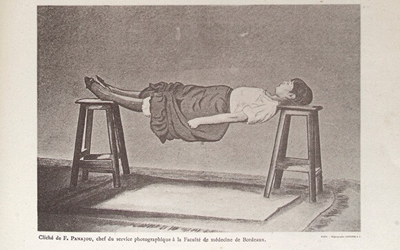 Spasms in hysterical patients | Source: Wellcome Images